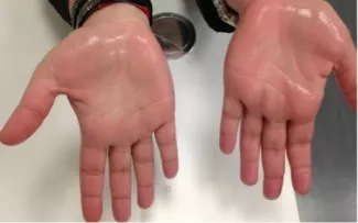 Hyperhidrosis showing excessive sweating on open hands