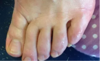 Image of foot with Plantar Hyperhidrosis